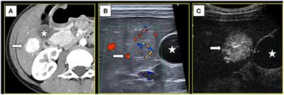 Case Report: Ultrasound-Guided Percutaneous Microwave Ablation of Focal Nodular Hyperplasia in a 9-Year-Old Girl